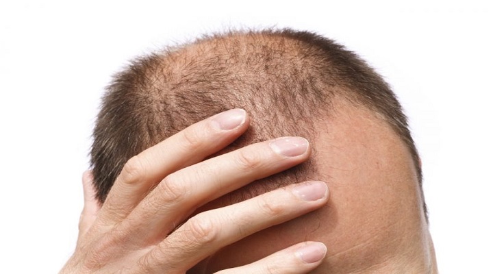 روش درمانی جدید برای طاسی و ریزش مو در آقایان
